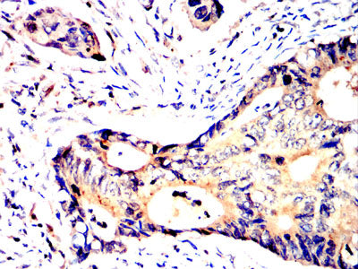 설명: Figure 7:Immunohistochemical analysis of paraffin-embedded rectal cancer tissues using SV2C mouse mAb with DAB staining.